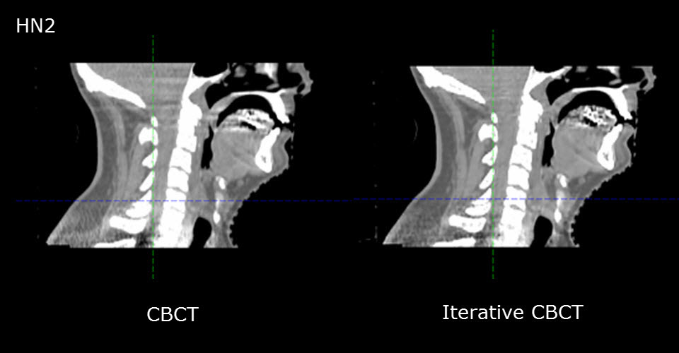 FBP, Iterative